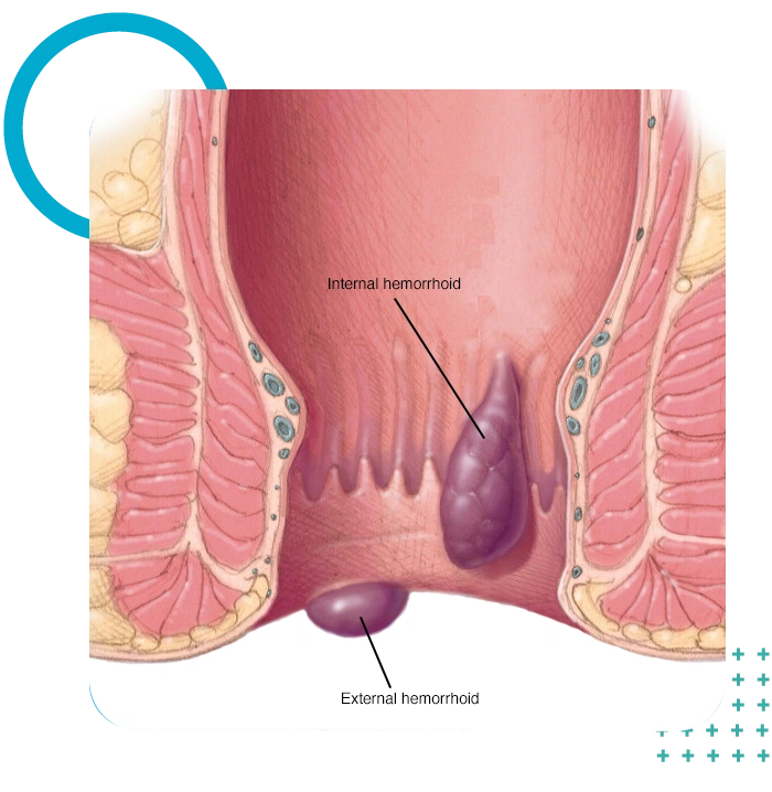 ligadura img